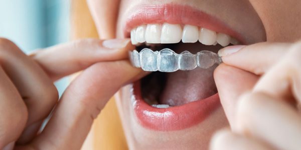 neobianco_banner_invisalign